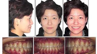 Class III malocclusion treated with distalization of the mandibular dentition with