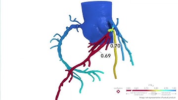 HeartFlow | Non-Invasive Coronary Artery Disease Detection