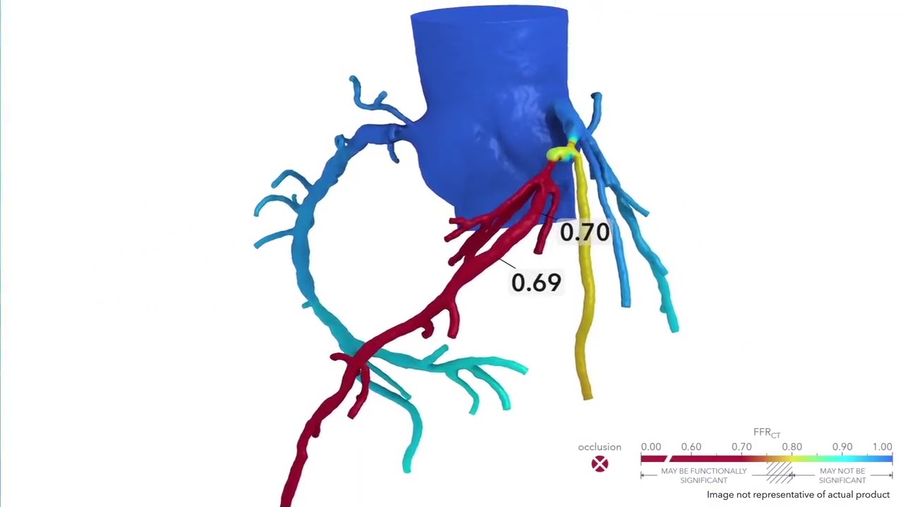HeartFlow | Non-Invasive Coronary Artery Disease Detection - YouTube