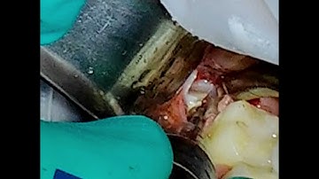 Lingually Inclined, Distoangular Third Molar Removal