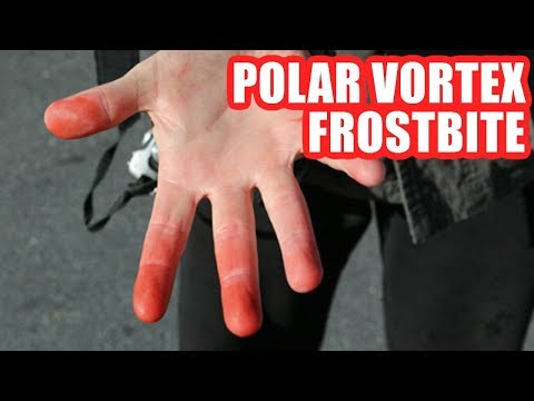 How to Prevent Frostbite in Extreme Cold Weather - The Prevention & Treatment Explained!