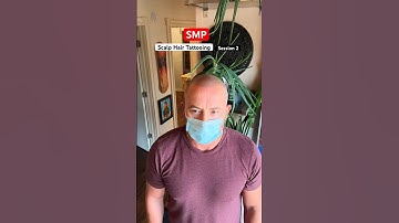 Scalp micropigmentation session 2 SMP #smp #scalpmicropigmentation
