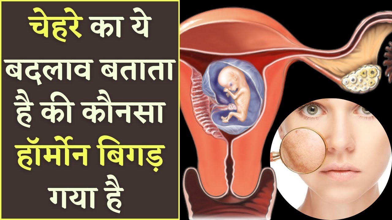 चेहरे का ये बदलाव बताता है की कौनसा हॉर्मोन बिगड़ गया है || 𝗙𝗔𝗖𝗜𝗔𝗟 𝗦𝗬𝗠𝗣𝗧𝗢𝗠𝗦 𝗢𝗙 𝗛𝗢𝗥𝗠𝗢𝗡𝗘 𝗜𝗠𝗕𝗔𝗟𝗔𝗡𝗖𝗘