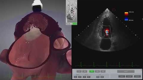 HeartWorks Mitral Stenosis