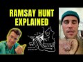 Doctor Explains Ramsay Hunt Syndrome As Seen With Justin Bieber Causing Facial Nerve Paralysis Doctor Explains Ramsay Hunt Syndrome As Seen With Justin Bieber Causing Facial Nerve Paralysis