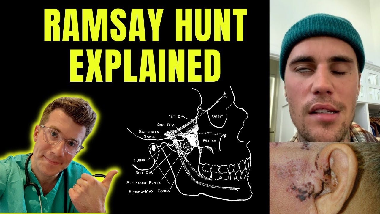 What is Ramsay Hunt Syndrome and how has it affected Justin ...