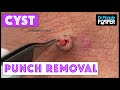 Follow up and a New Cyst Punch from "Big Back Blackheads"