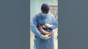 ما شاء الله حجم المعدة بعد عملية التكميم 