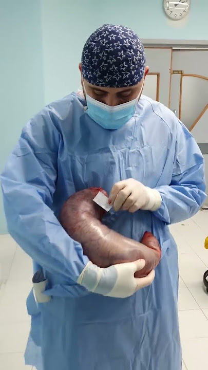 ما شاء الله حجم المعدة بعد عملية التكميم