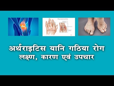 Arthritis | आर्थराइटिस(गठिया) लक्षण,  कारण, उपचार | Dr. Prakash Arora