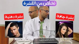 علاج القشرة بشكل نهائي - اسباب القشرة و الاكزيما الدهنية