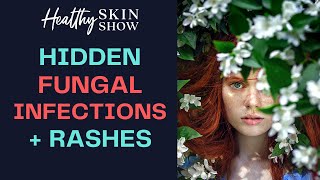 How HIDDEN Fungal Infections Can Cause Skin Rashes | Dr. Jess Peatross
