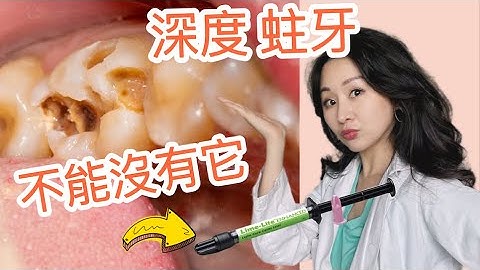 『補牙必看』出現這個狀況 要馬上跟牙醫說！補牙完 牙齒變敏感？@DrTeresa - 天天要聞