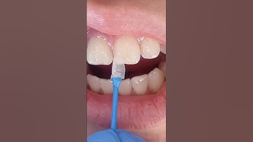 Dán sứ Veneer có hại răng thật không? #rangthua #ranghoke