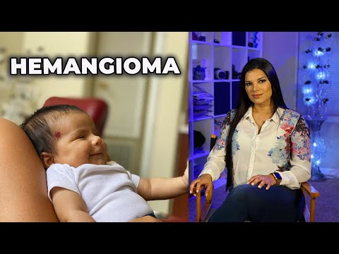 Vídeo: Angioma - Sintomas, Tratamento, Tipos