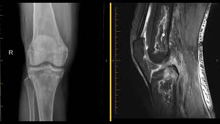 Avascular necrosis (AVN) osteonecrosis of knee
