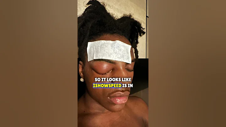 IShowSpeed Eye Injury 😳
