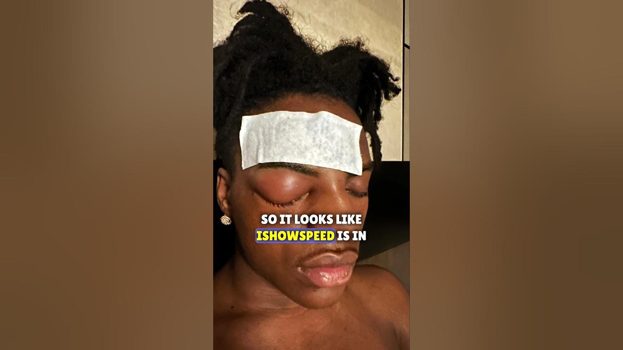 IShowSpeed Eye Injury, What Happened to IShowSpeed's Eye? - News