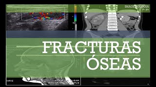 Fracturas 脫seas Fracturas 脫seas