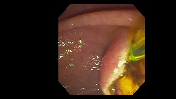 ERCP with sphincterotomy