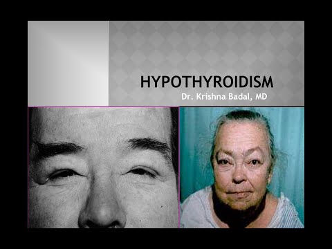 Video: Myxedema - Symptomer, årsager, Diagnose, Behandling, Prognose