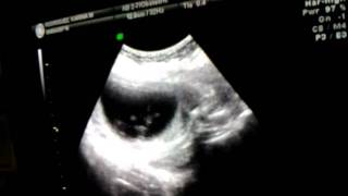 9222011 Ultrasound Baby Mason
