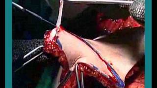 Ftm SRS Gender Reassignment Surgery Perovic Total Phalloplasty