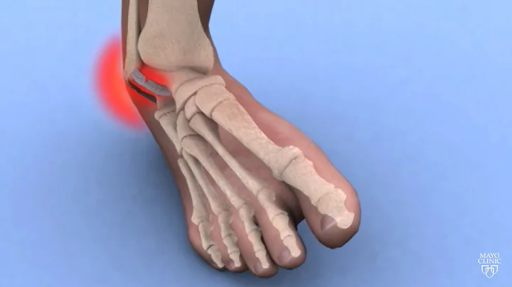 Mayo Clinic Minute: Ankle sprains 101 - DayDayNews