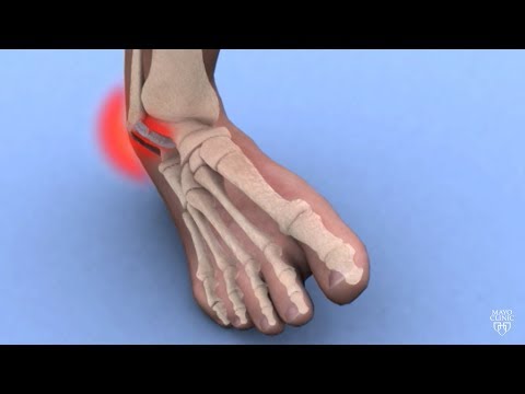 Mayo Clinic Minute: Ankle sprains 101