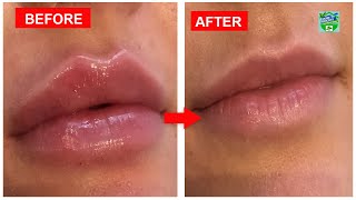 How To Treat Swollen Lips At Home With Natural Remedies