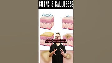 Foot CORNS & CALLUSES: How To Get Rid Of Them For Good!
