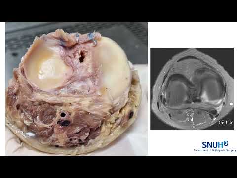 슬와동맥의 해부학 및 손상방지 (Cadaveric anatomy of the popliteal artery and  injury prevention)