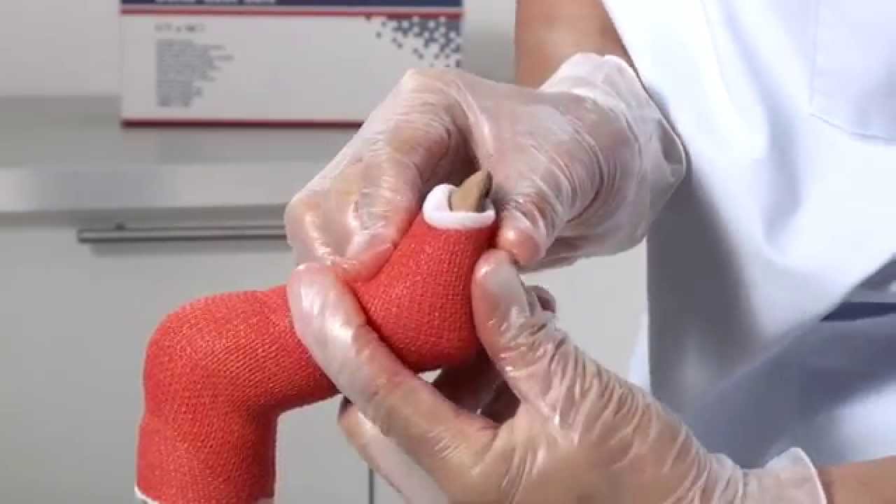 Delta Cast Soft Club Foot Cast Application Youtube