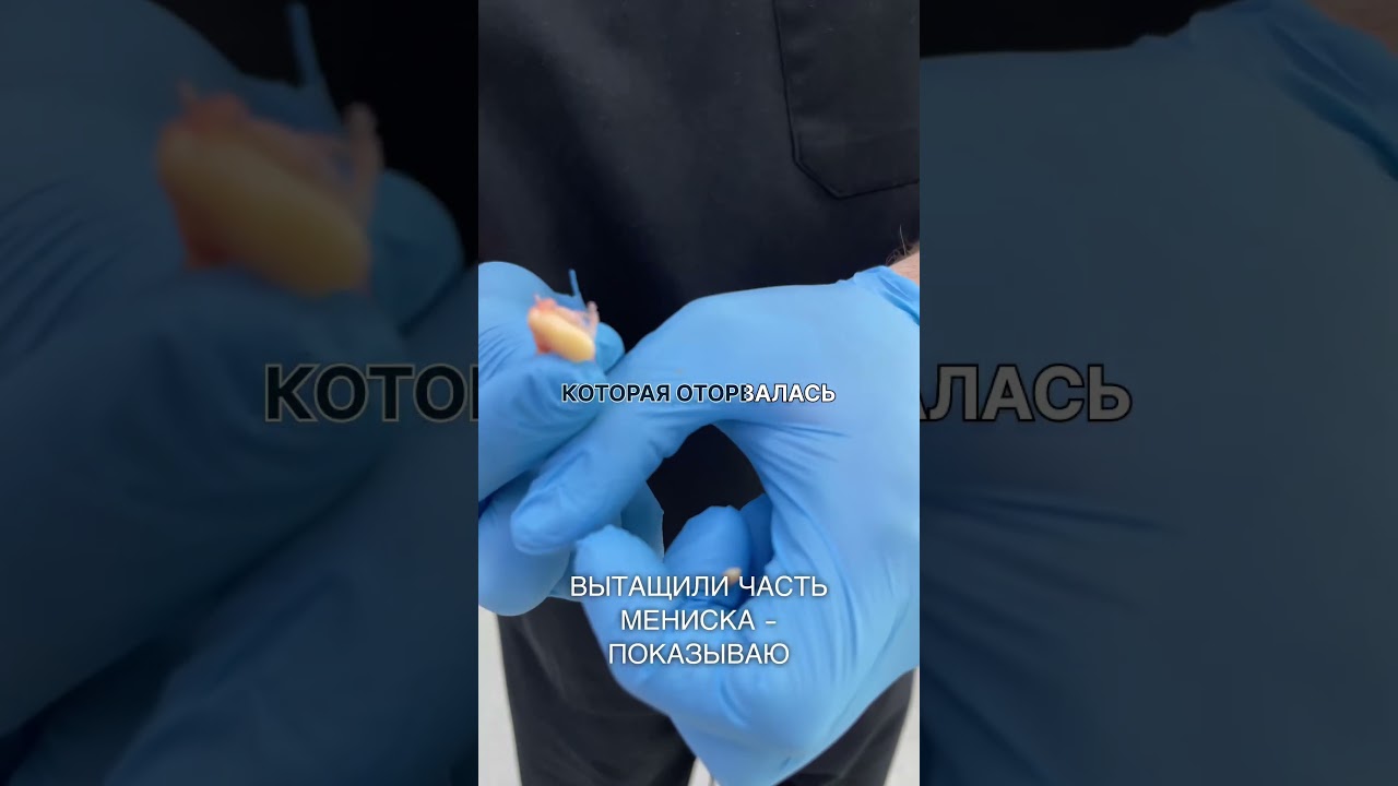 ВЫТАЩИЛИ ЧАСТЬ МЕНИСКА - ПОКАЗЫВАЮ