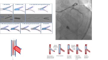Coronary bifurcation stenting part 2: two-stent techniques- Crush, DK-Crush, Culotte
