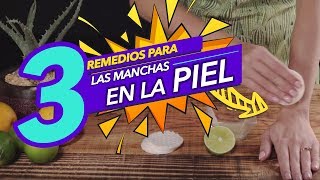 Los mejores remedios para eliminar las manchas en la piel Los mejores remedios para eliminar las manchas en la piel