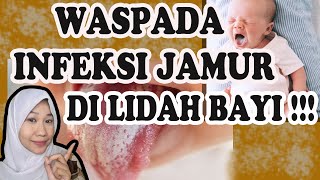 Lidah Putih Atau Jamur Pada Bayi Penyebab, Cara Mencegah Dan Cara Mengatasi