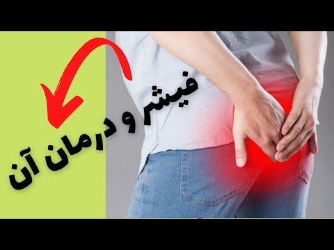 درمان فیشریا شقاق مقعدی درمان شقاق مقعدی در طب سنتی چیست
