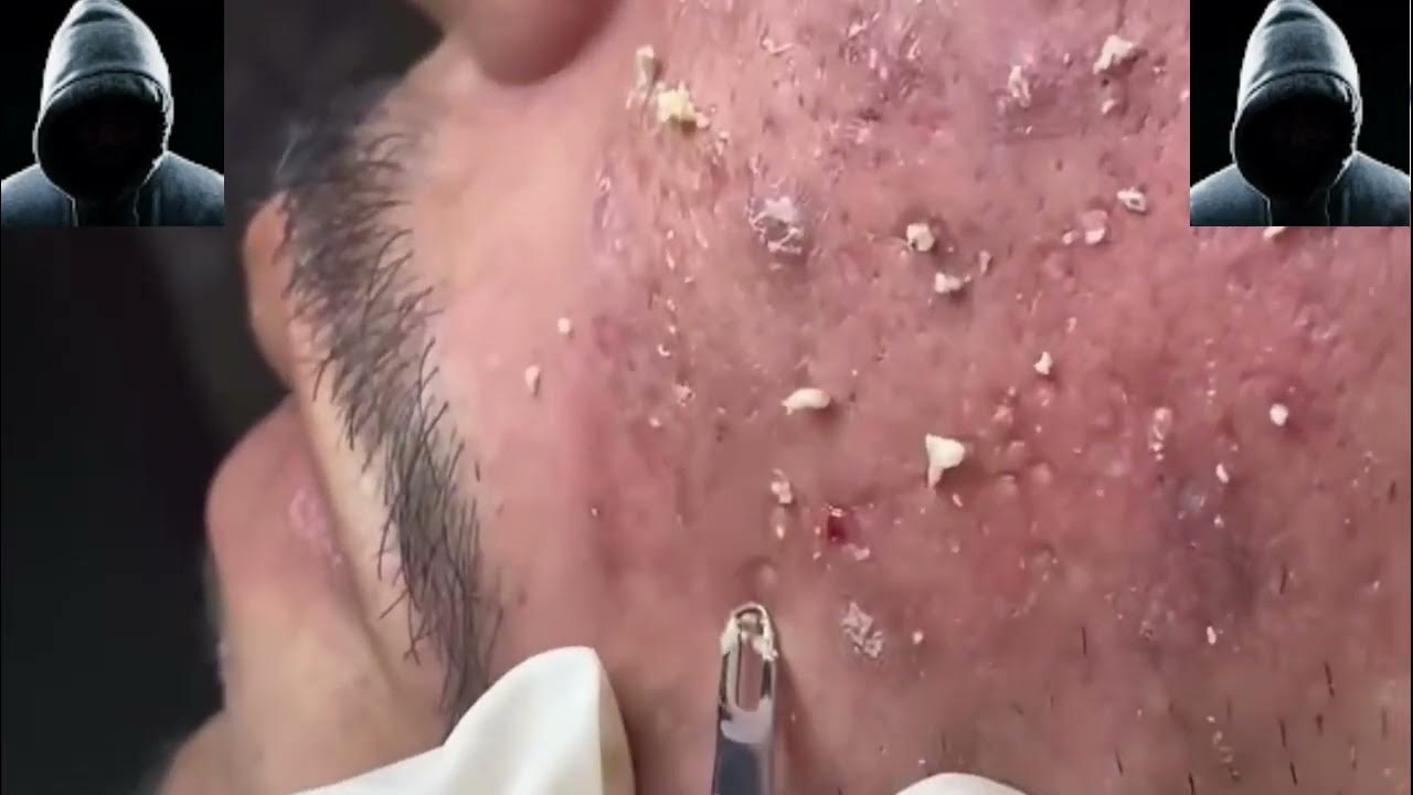 Acne treatment, pimples popping, blackhead removal on the nose 430
