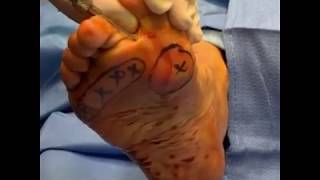 Download Lagu Foot Fat Grafting MP3