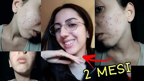 A cosa serve la crema clindamicina same?
