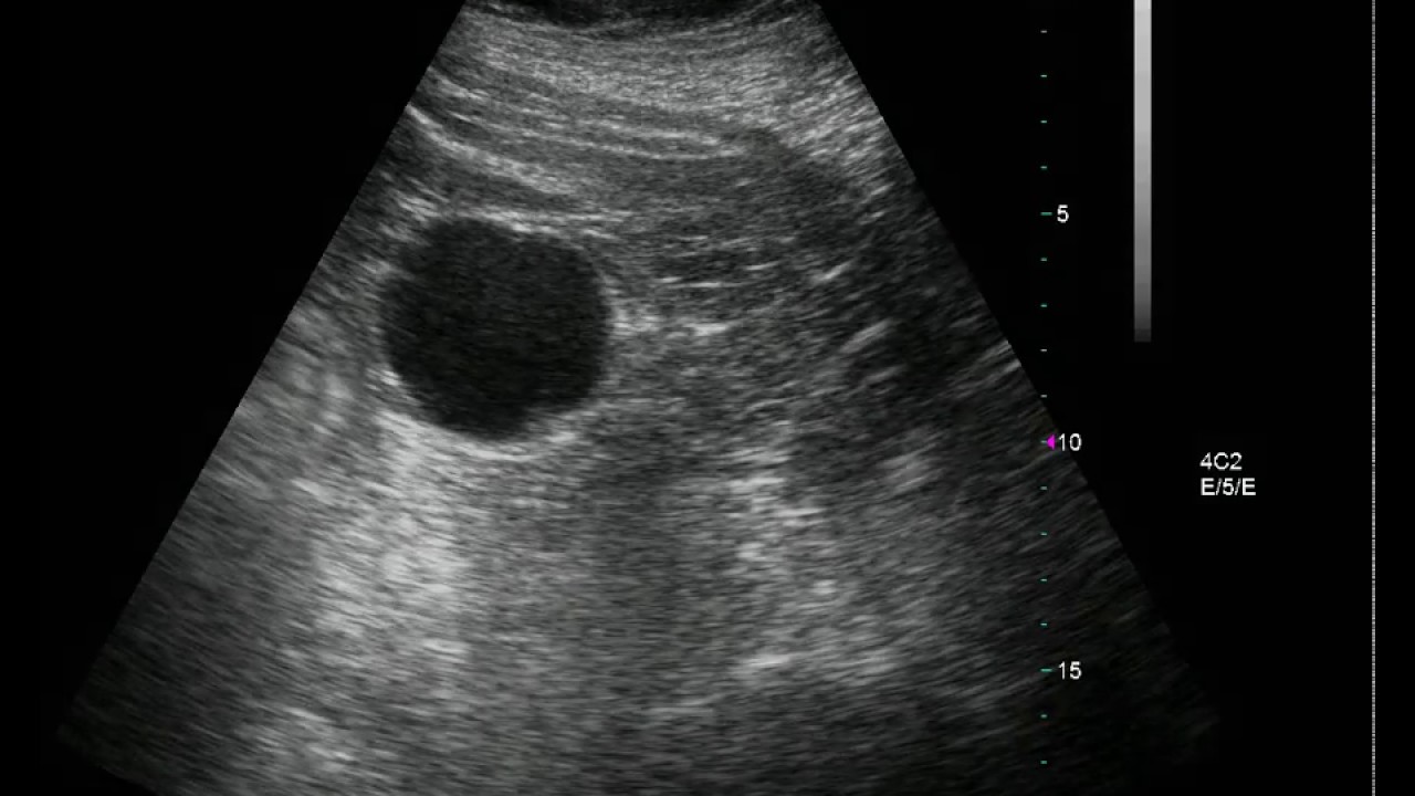 calcoli nella prostata e nella vescica scan video calcoli nella prostata e nella vescica scan video