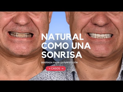 Testimonio - Tetraciclina & su solución con carillas dentales - by Dr. Ferran LLansana