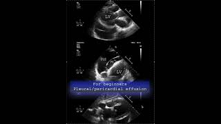 For beginners  Pleural/pericardial effusion #echocardiography #cardiologytraining
