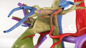 Extended left hepatectomy for advanced Klatskin tumour