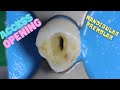 Access Opening of Mandibular Premolar | step by step demonstration