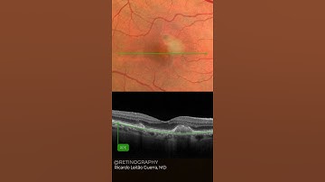Acquired vitelliform lesion
