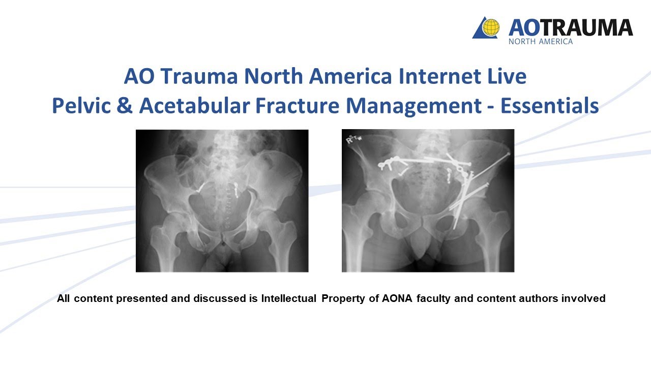 Pelvic & Acetabular Fracture Management Essentials Week 8 - YouTube