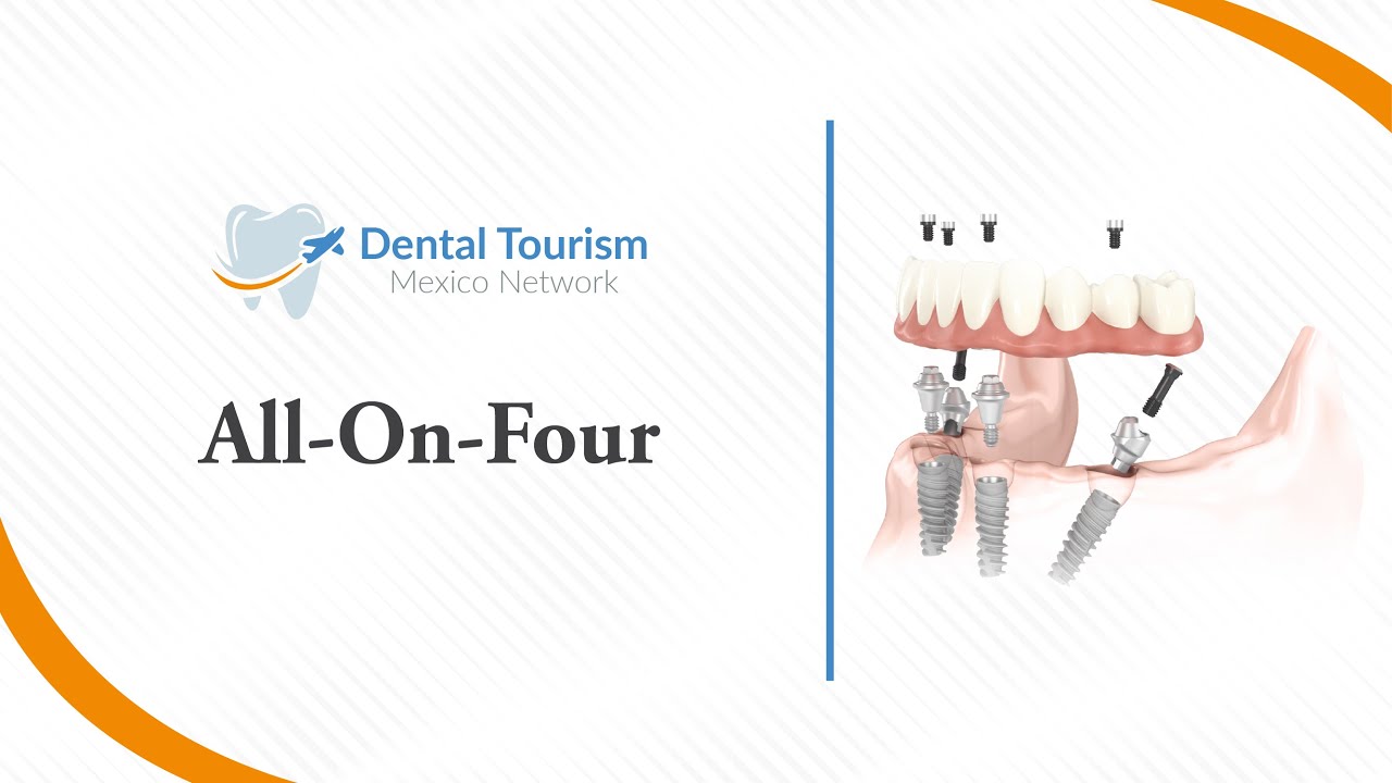 All on Four Ciudad de Mexico - Dental Tourism Mexico