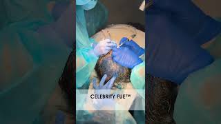 A hair transplant without shaving your head